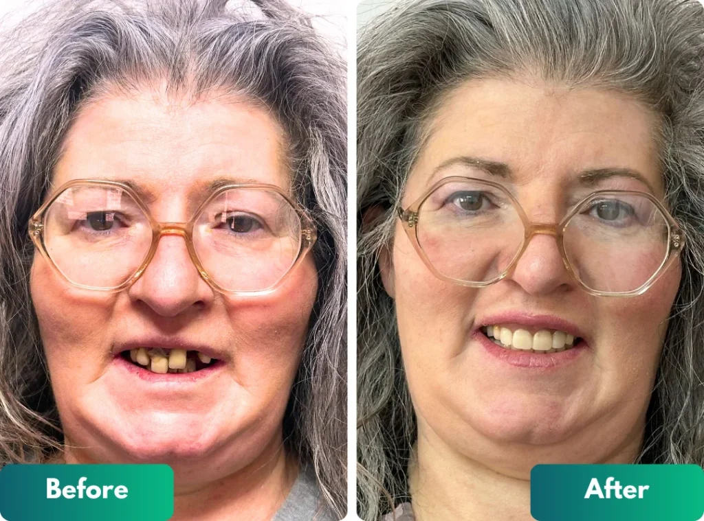 Revolutionary Zygomatic Implants